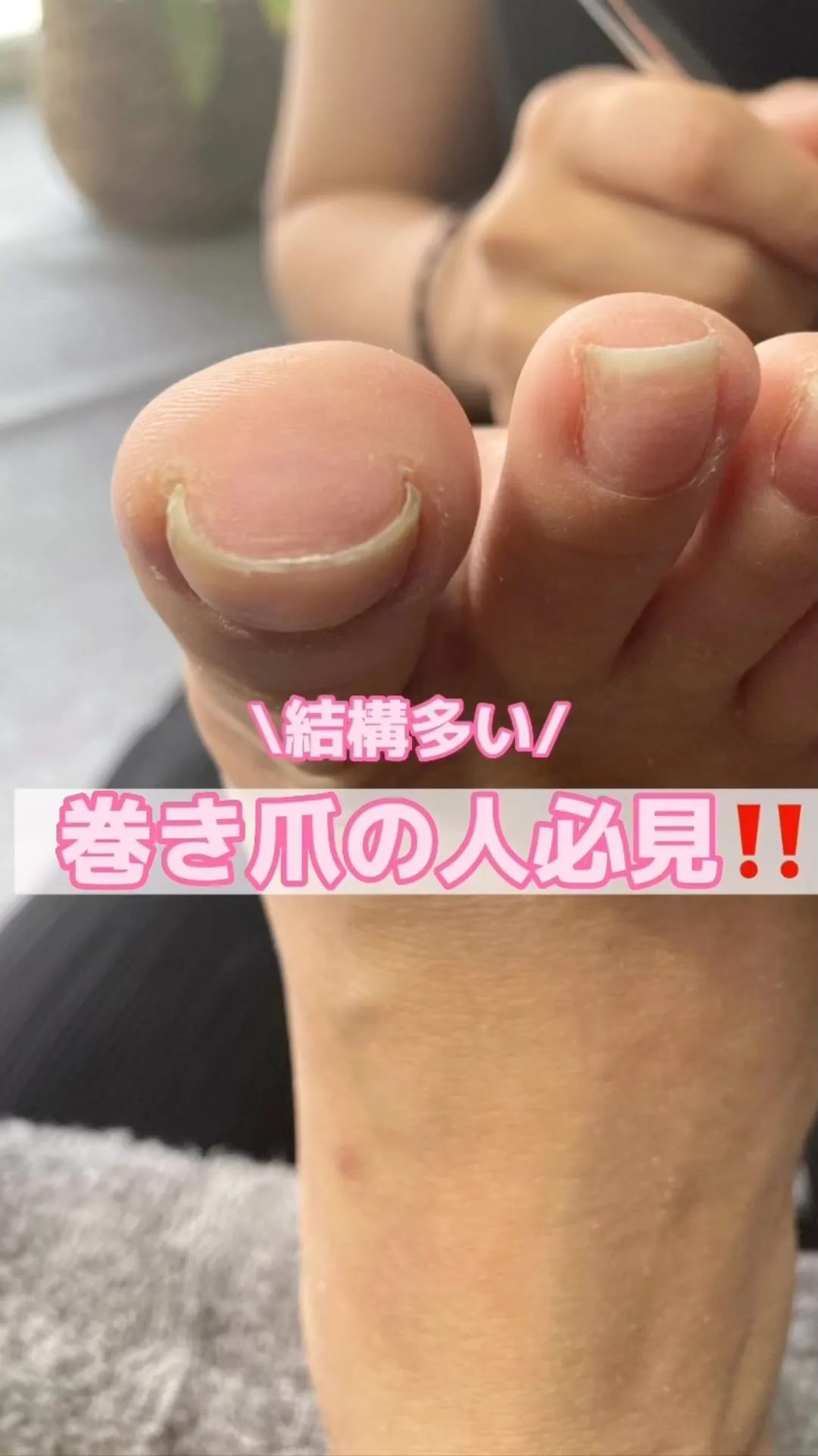 『巻き爪の方必見‼️』